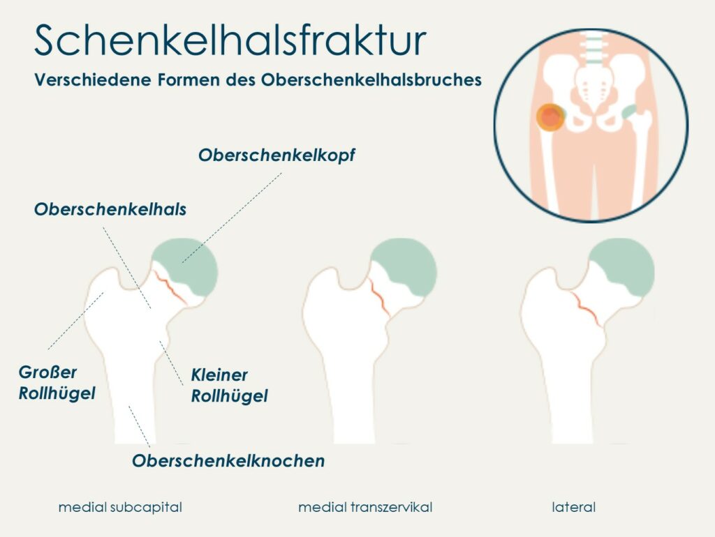 (Quelle: nach https://www.gesundheit.gv.at/krankheiten/koerper/oberschenkelhalsbruch.html)