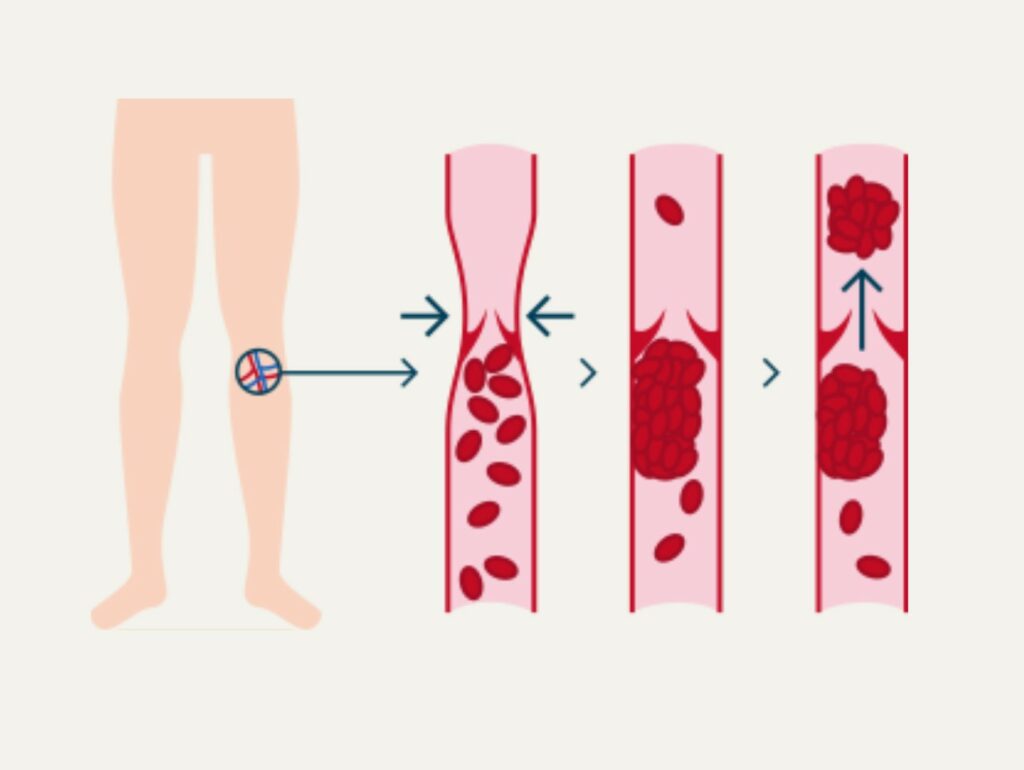Thrombose_Schaubild