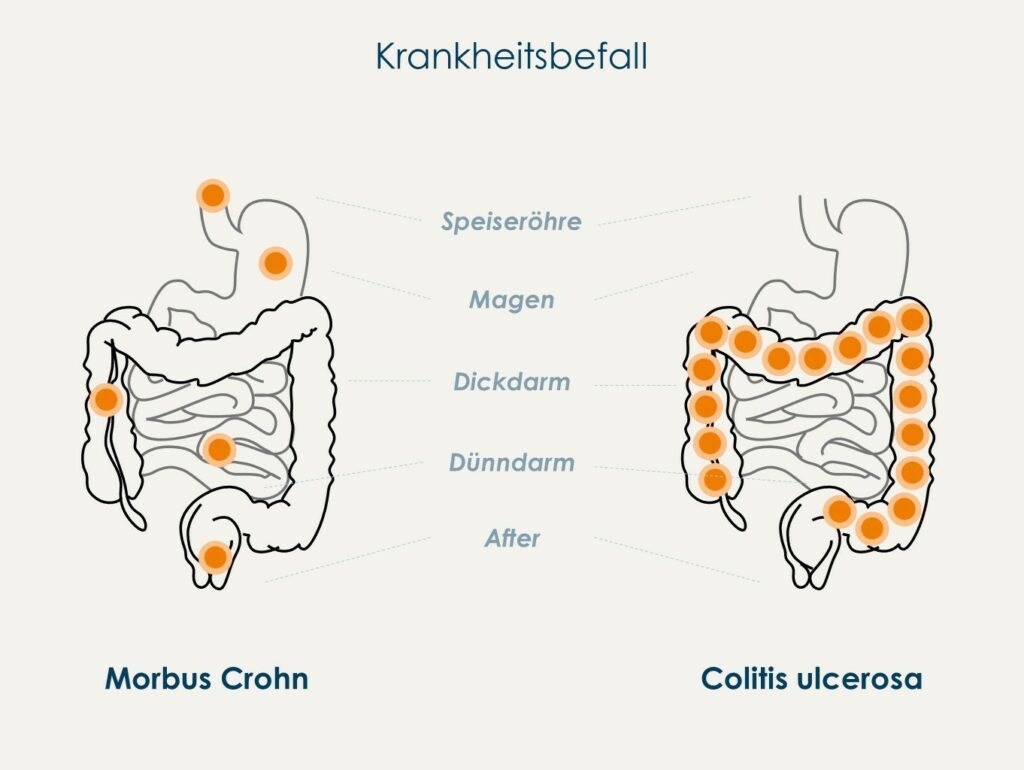 Pflege bei Morbus Crohn u Colitis ulcerosa