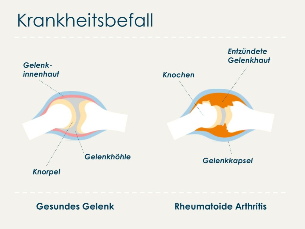 Bei rheumatoider Arthritis greift die Entzündung der Gelenkinnenhaut auf Knorpel und Knochen über. (Abb. in Anlehnung an "kurz & knapp"-Faltblatt "Rheumatoide Arthritis" der Deutschen Rheuma-Liga)